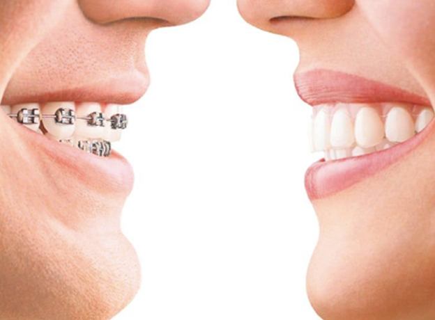 Invisalign Benefits