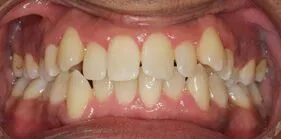 ms before