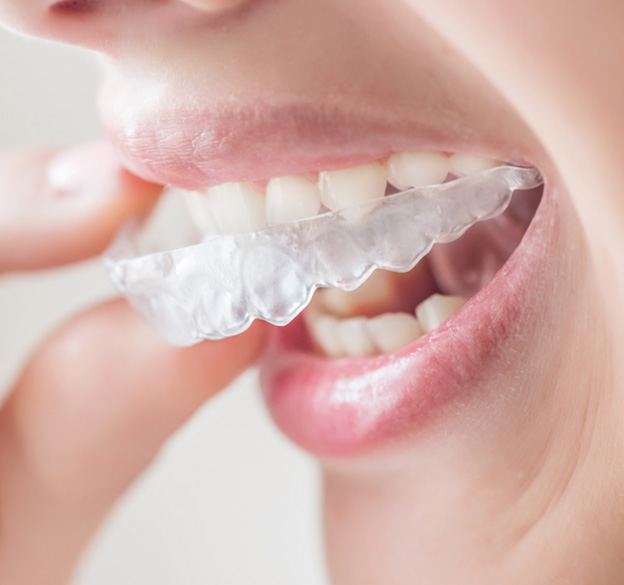 removable braces and aligners
