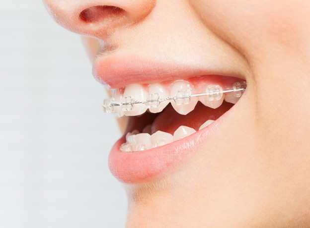 tooth coloured ceramic braces